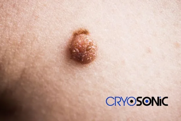 Are you looking for local Dermatofibroma Removal Bristol? Contact our team today in Colchester