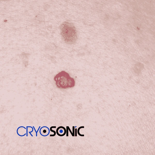 Looking for pain free cherry angioma removal treatment Colchester? Call our team today! Colchester