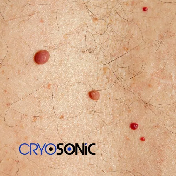 get cherry angioma removal treatment today! Colchester