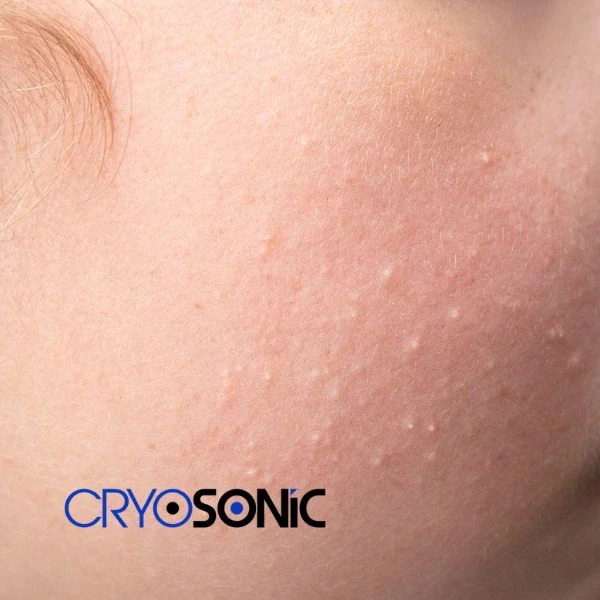 Are you looking for milia removal treatment? Contact our team today Colchester