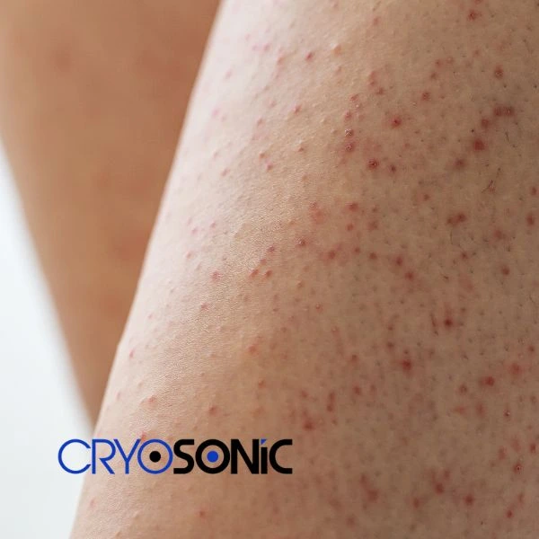 Looking for Seborrhoeic Keratosis removal Colchester treatment? Call our consultants today in Colchester