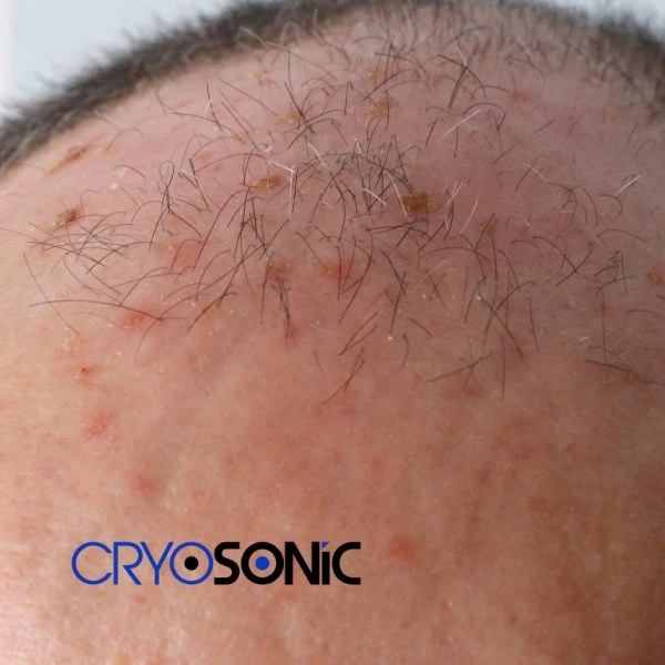 Access Seborrhoeic Keratosis removal from the comfort of your own home! Call us today in Colchester