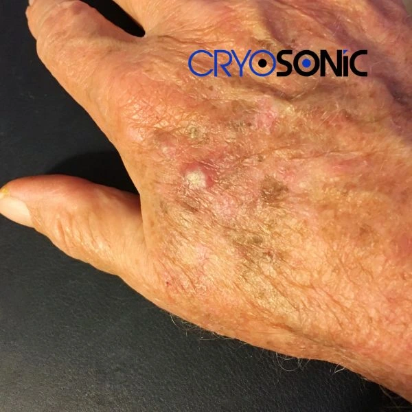 Understand more about actinic keratosis treatment today Colchester
