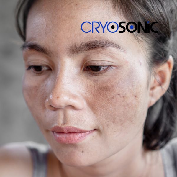 Ready to start age spots removal? Contact our team today in Colchester