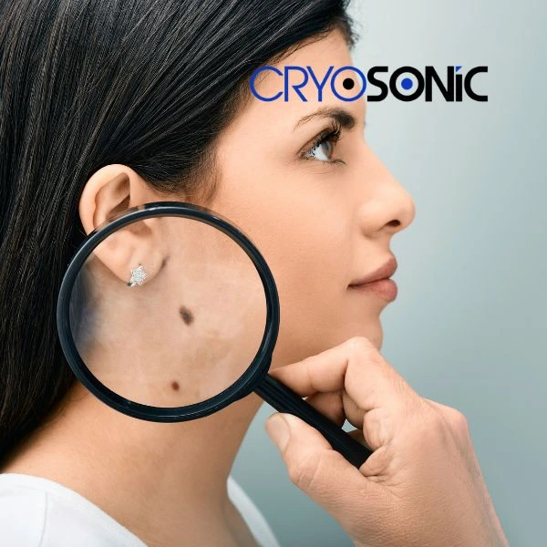 Do you want to learn more about benign moles removal treatment? Call our team today Colchester