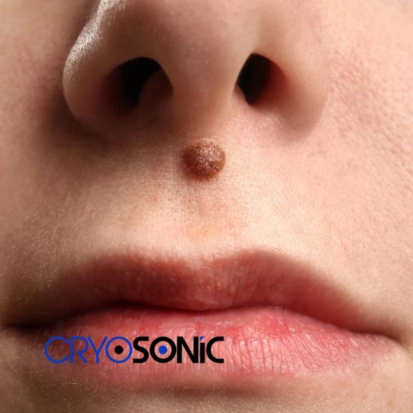 Start your benign moles removal treatment today Colchester
