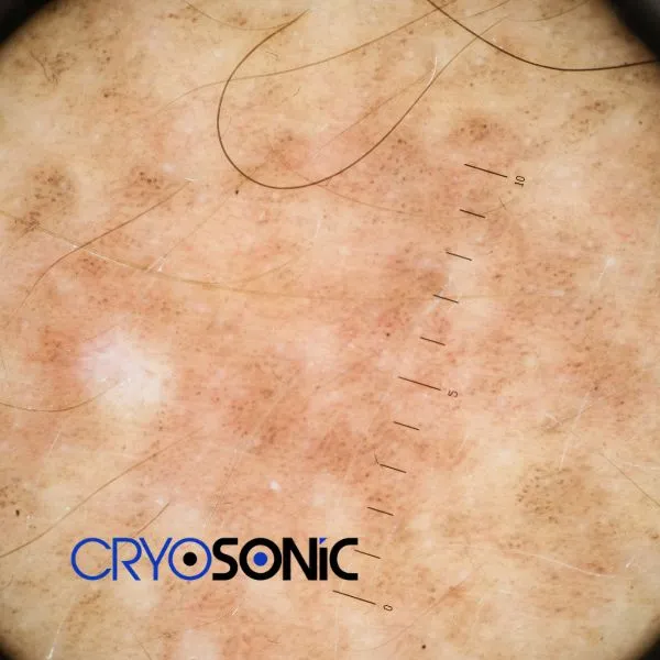 Speak to our team today about sun damaged skin treatment today in Colchester
