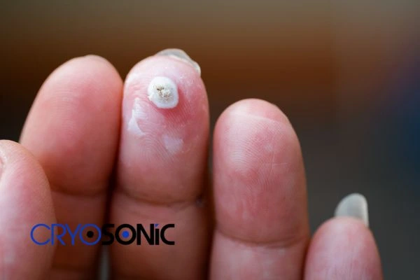 Cryotherapy being used to remove plantar warts Colchester