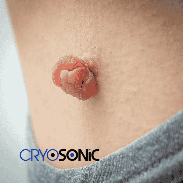 Book your skin tags removal Colchester from comfort of your own home! Colchester