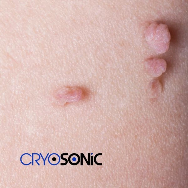 Are you looking for fast effect skin tag removal Colchester? Book in NOW! Colchester