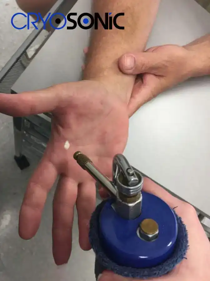 Temperature Differences: OTC vs Medical-Grade Cryotherapy Colchester